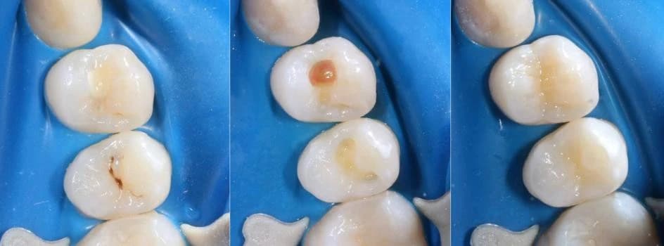 Эстетическая реставрация