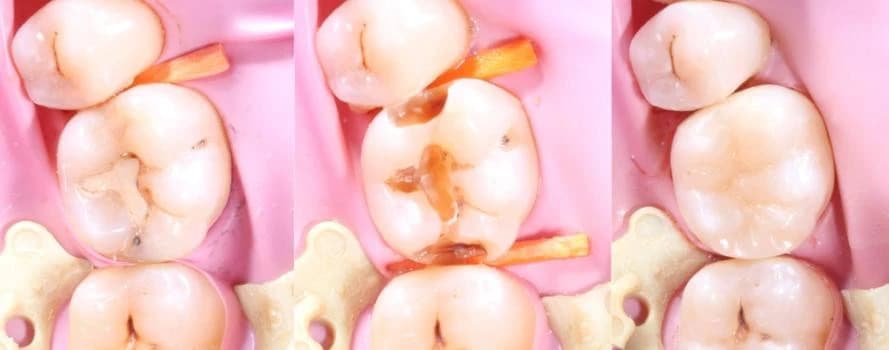 Лечение кариеса с восстановлением стенок зуба