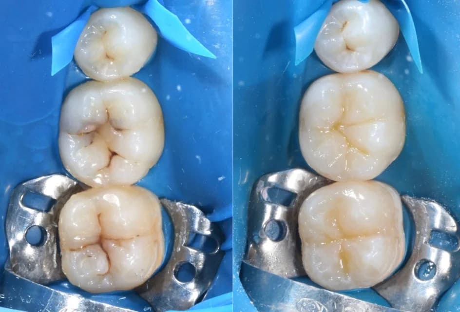 Реставрация с учётом анатомии и цвета