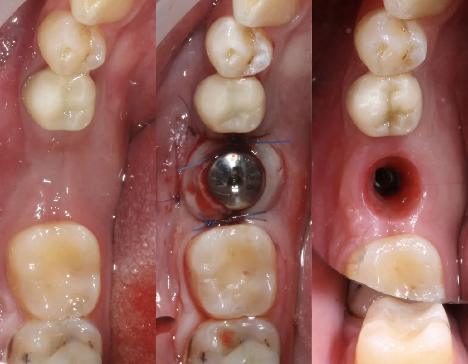 Дентальная имплантация с пластикой десны