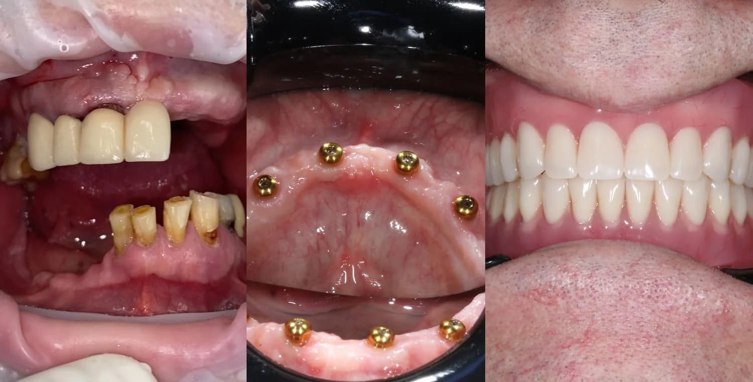 Тотальная реабилитация на имплантатах с локаторами
