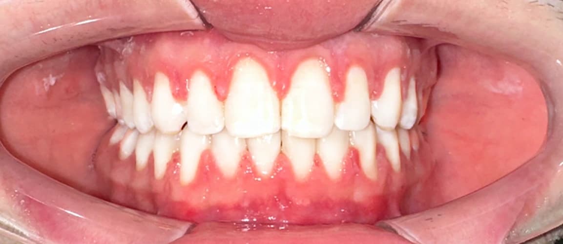 Брекет-система на верхней и нижней челюсти