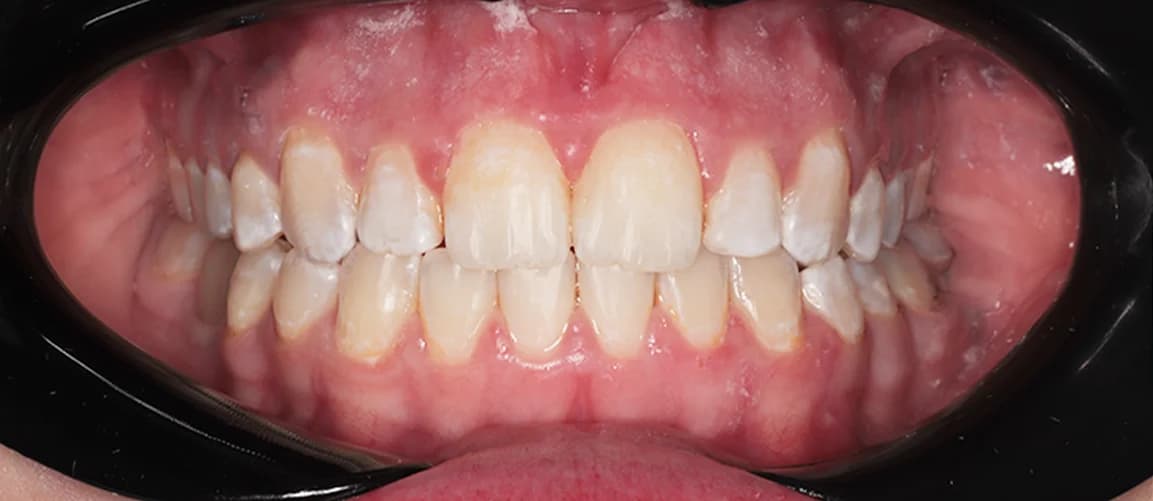 Ортодонтия при асимметрии без хирургии