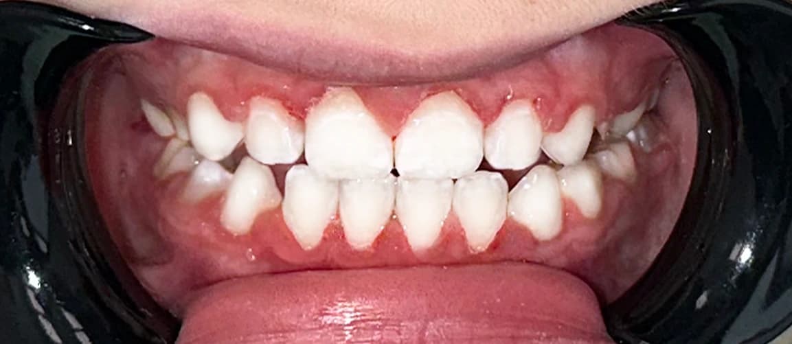 Двухэтапное лечение: пластинка и частичные брекеты