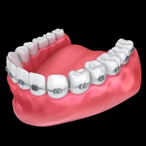 Несъемные способы