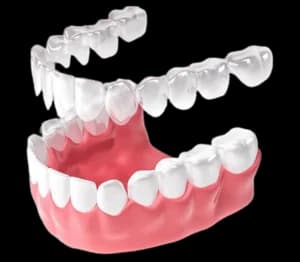 Коллаж: прозрачный элайнер и брекет-система на зубах — визуальное сравнение методов ортодонтии