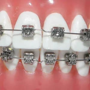Металлические брекеты