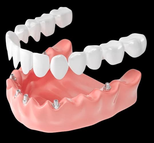 Полное протезирование на 6 имплантах