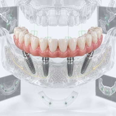 полное восстановление на имплантах Dentium