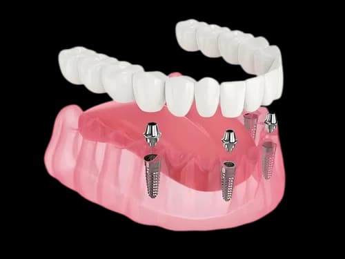 All-on-4 протез