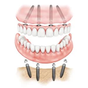 All-on-6 на верхней и нижней челюсти