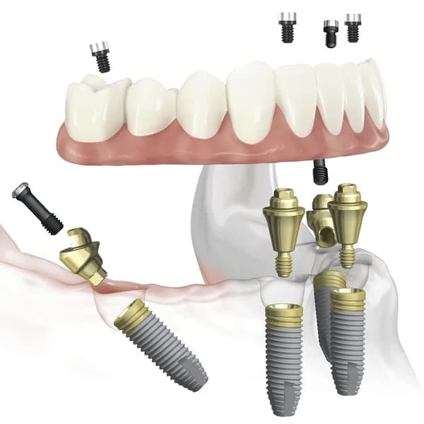 Имплант-системы для зубной имплантации: Dentium, Straumann, Vega