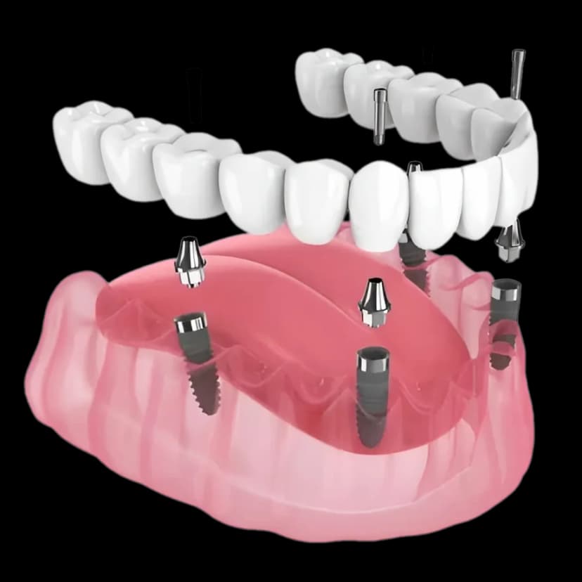 Полное протезирование на 4-х имплантах