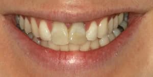 Пятна на зубах