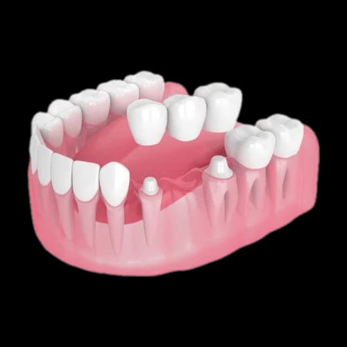 Уход за металлокерамической коронкой