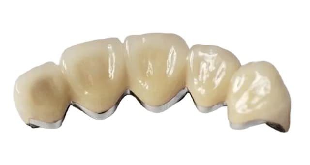 Металлокерамическая коронка на зуб