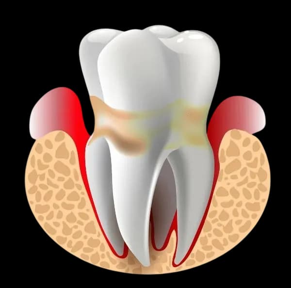Крупный план зубной щётки у края десны: иллюстрация к теме кровоточивости дёсен и профилактики гингивита