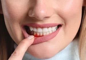 больные десна