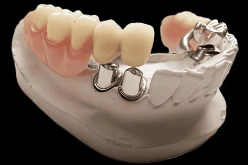 Бюгельный протез на телескопических коронках