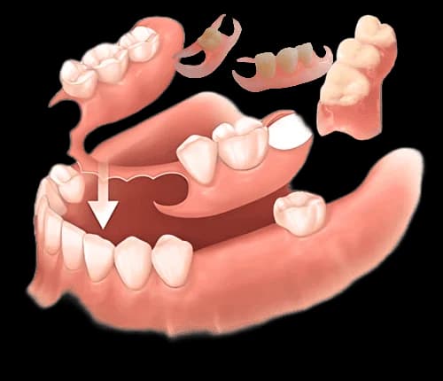 гибкий частичный протез