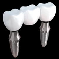 Мостовидный протез на имплантах