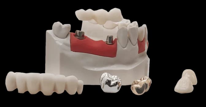 Варианты условно-съемного протезирования