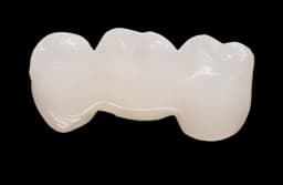 Мостовидный протез из диоксида циркония