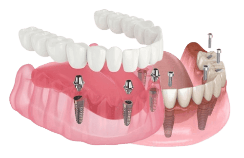 Улыбка с полным рядом зубов на имплантатах — концептуальное изображение к статье про All-on-4 и All-on-6