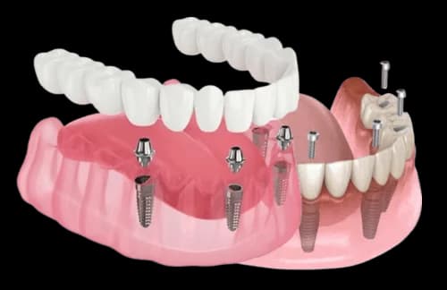 полное протезирование на имплантах