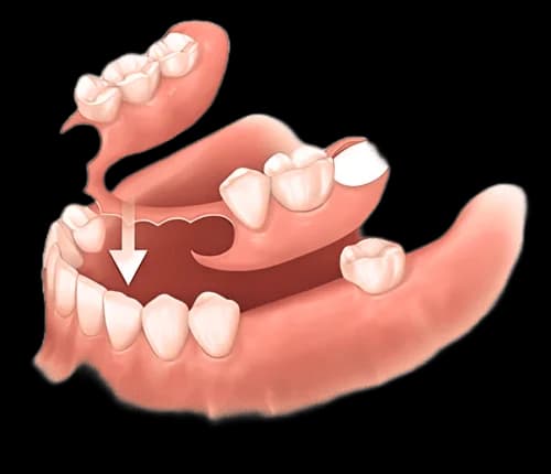 Зубной протез