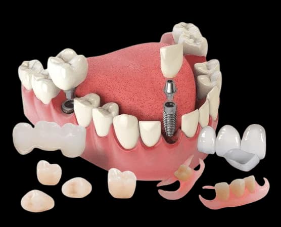 Современное протезирование зубов