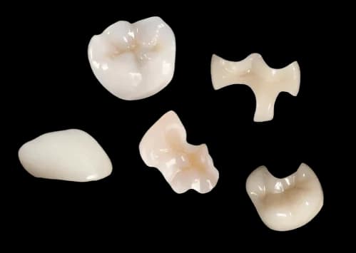 Керамическая вкладка