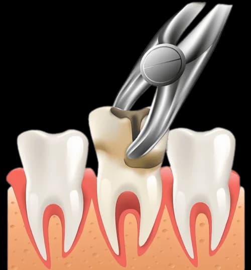 удаление по показаниям
