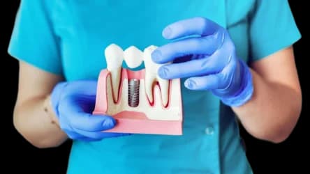 Имплантация зубов
