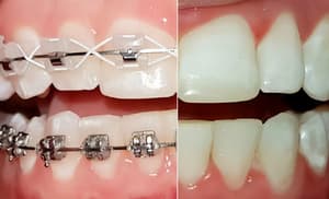 Снятие брекетов