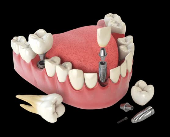 Улыбка, восстановленная с помощью имплантов Vega