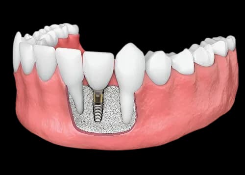 Костная пластика перед имплантацией
