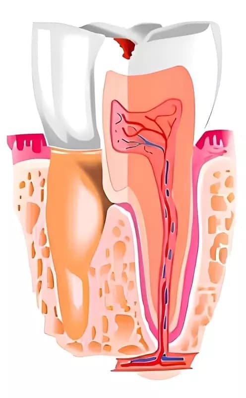 Схематичное изображение зуба с зонами кариеса и корня — образовательная иллюстрация к теме зубной боли