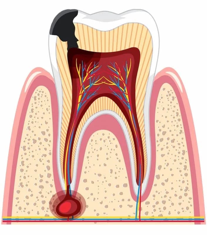 лечение периодонтита