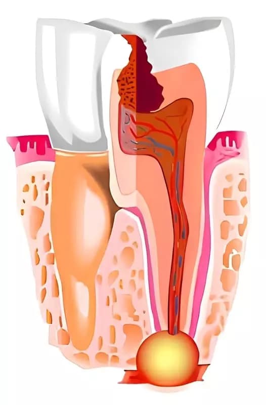 поражение нервов зуба