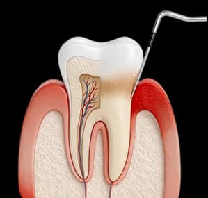 Схема: воспалённый десневой край и зона скопления зубного налёта у шейки зуба — визуализация причины кровоточивости
