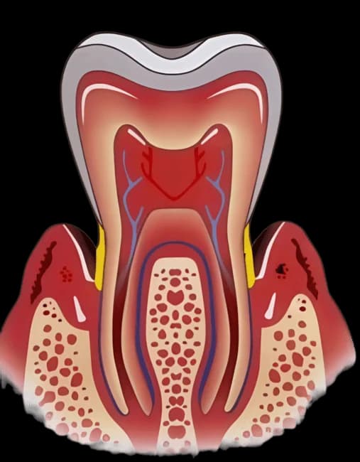 как выглядит пародонтит внутри зуба