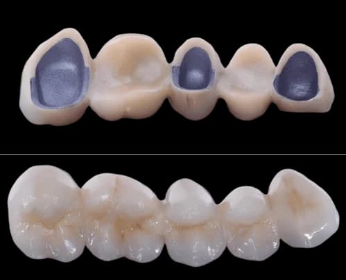 Металлокерамический мостовидный протез