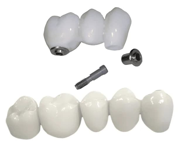 Мостовидный протез из диоксида циркония