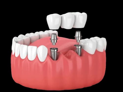 Коронки и мост на имплантах