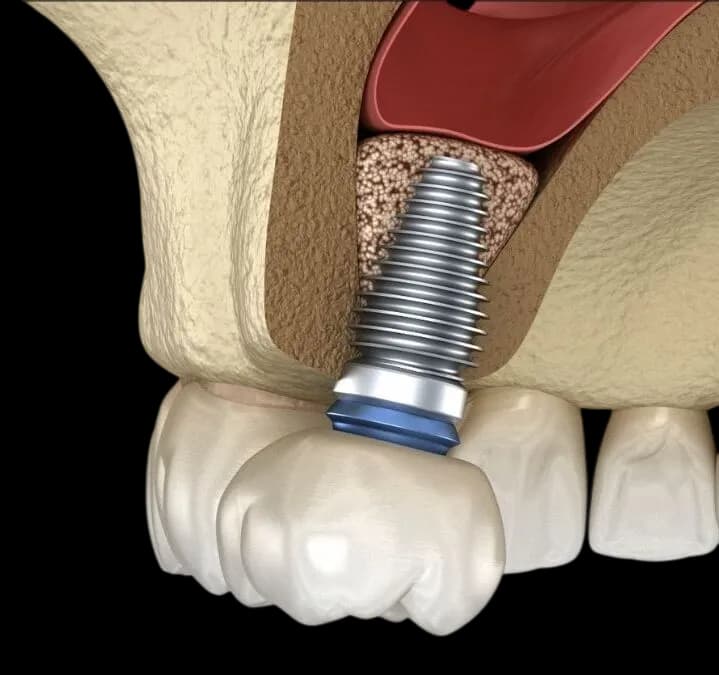 Синус-лифтинг и имплантация